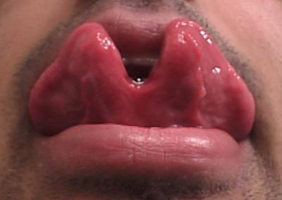 tongue completely split